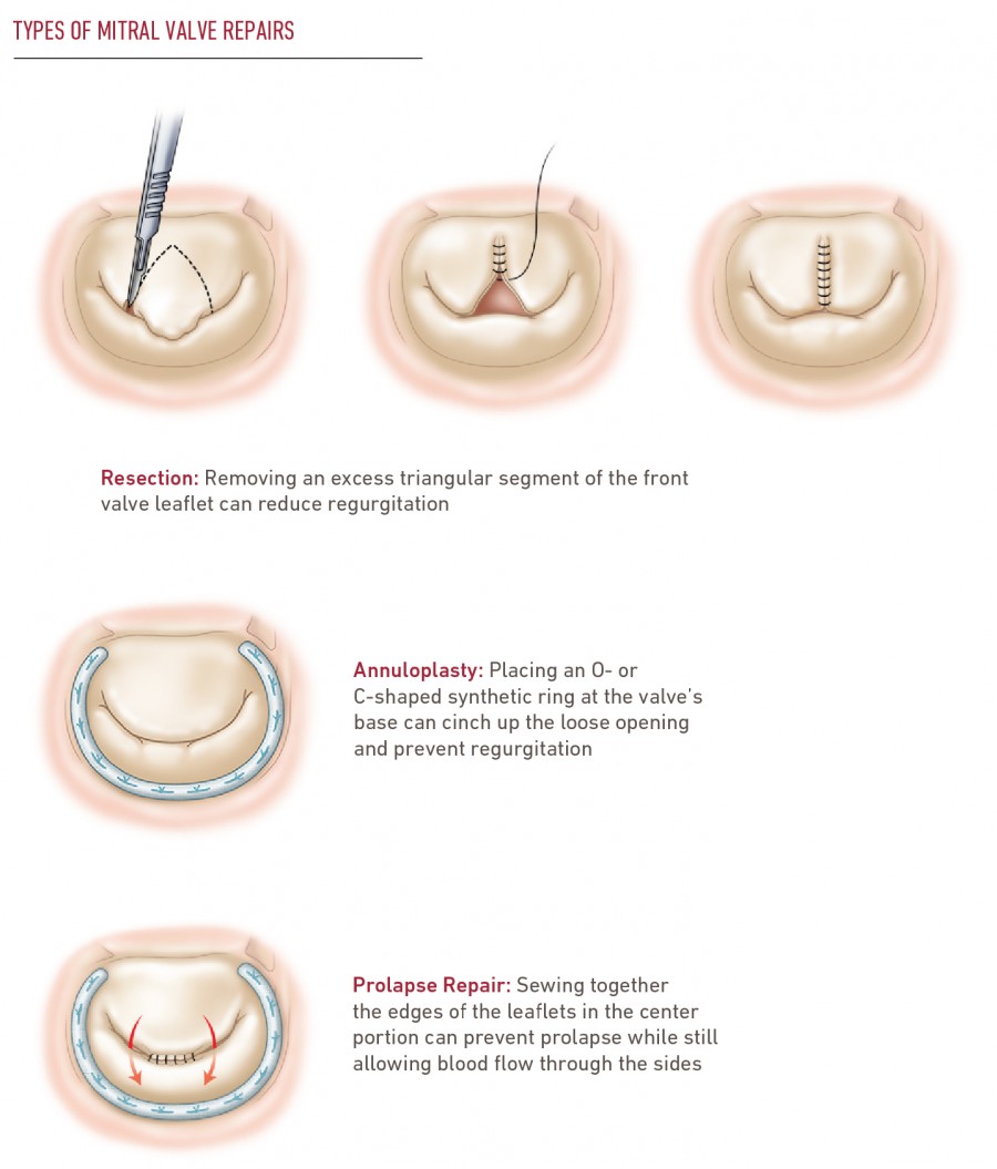 mitral-valve-repair-replacement-temple-health